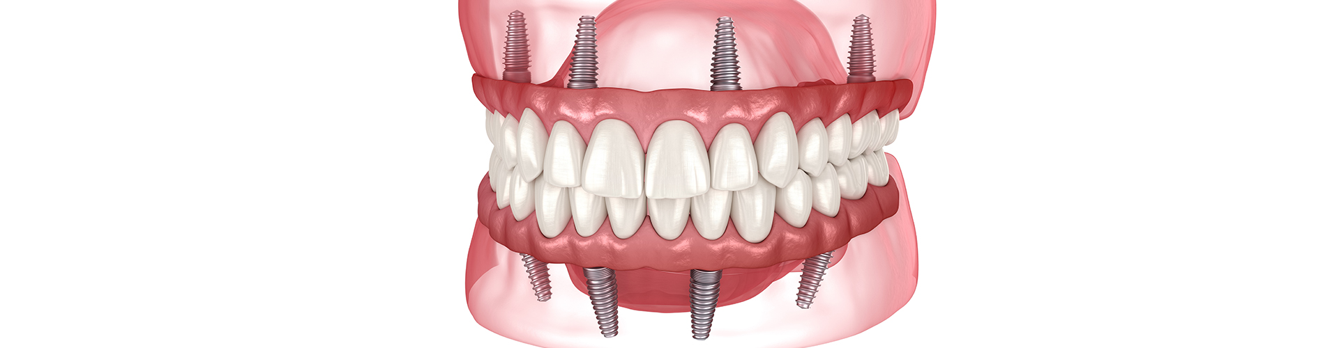 rendering of upper and lower implant-retained dentures